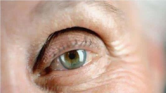 切割双眼皮视频,打造迷人电眼