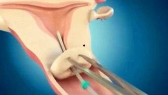 怎么上环的视频,视频教程详解